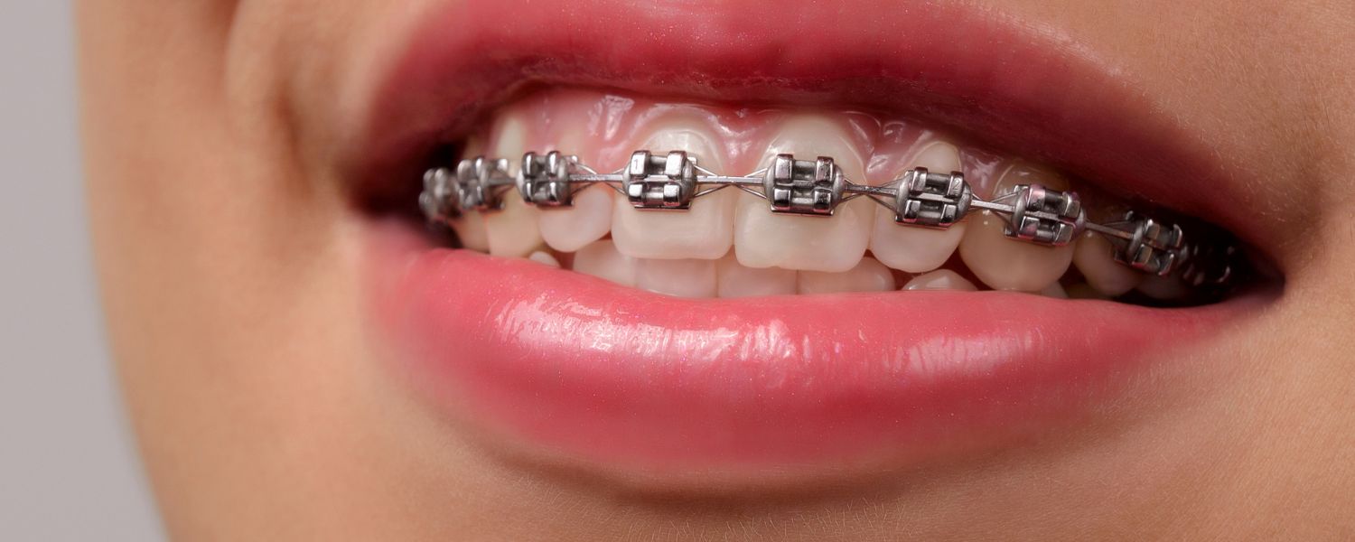 Can You Drink Bubble Tea With Braces? Bubblebase UK